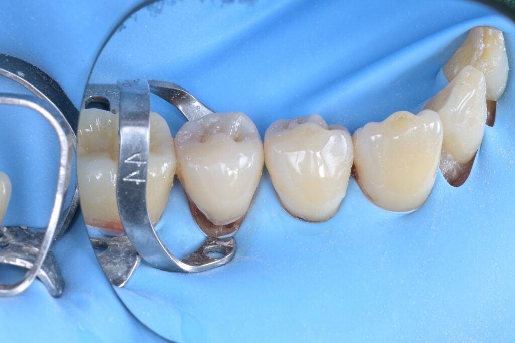 [치근우식] 잇몸 경계 부위가 썩었을 때, 왜 ‘러버댐’이 필수일까요? (Feat. 자연치아 살리기) - 레진빌드업 썸네일