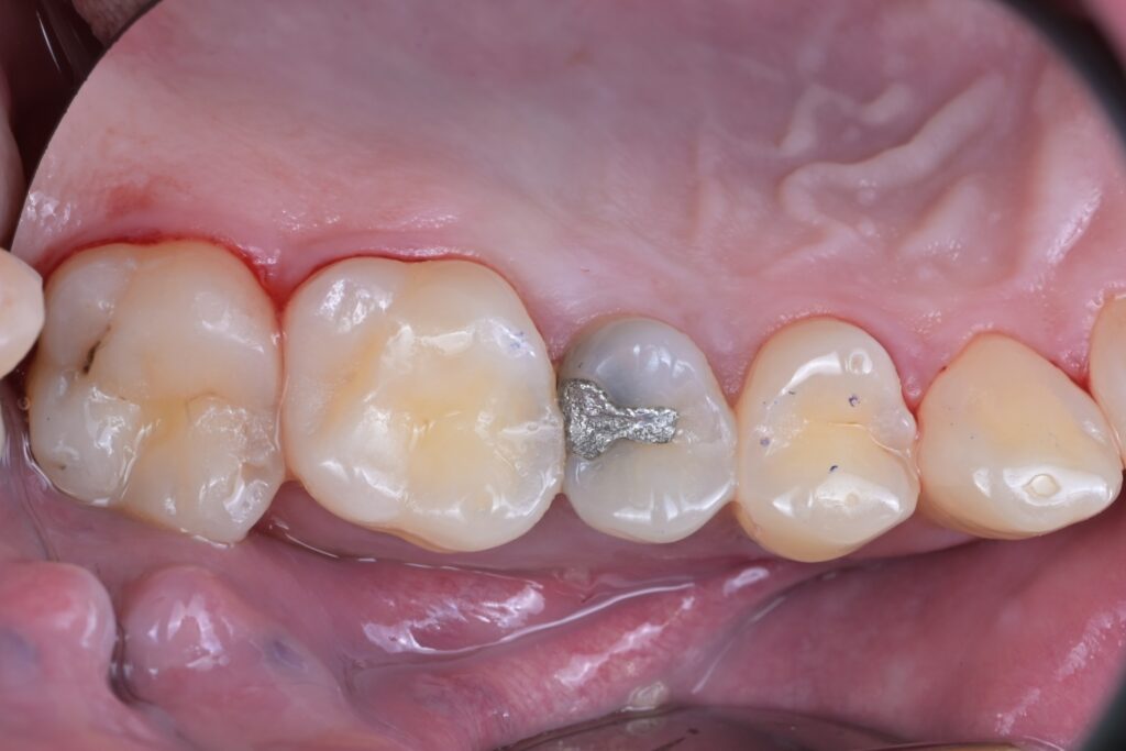 치료 전: 오래된 아말감 하방으로 2차 우식이 의심되는 상태