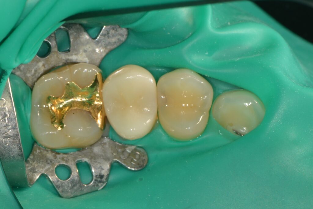 겉으론 멀쩡한데 속이 썩었다고요? 치아 사이 ‘인접면 충치’, 인레이 대신 ‘레진 빌드업’으로 치료한 증례 - 레진빌드업 썸네일