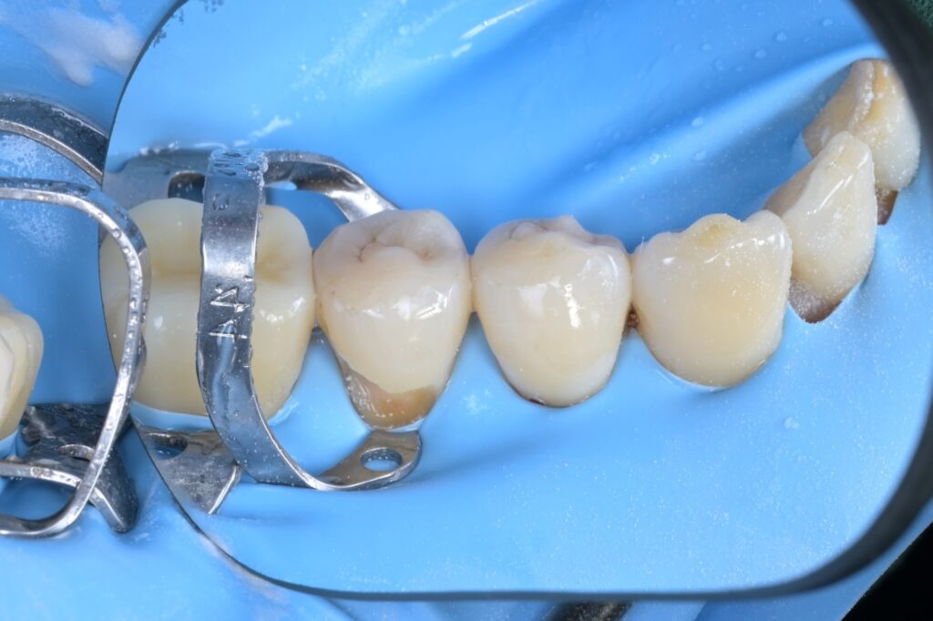 [치근우식] 잇몸 경계 부위가 썩었을 때, 왜 ‘러버댐’이 필수일까요? (Feat. 자연치아 살리기) - 레진빌드업 임상사진