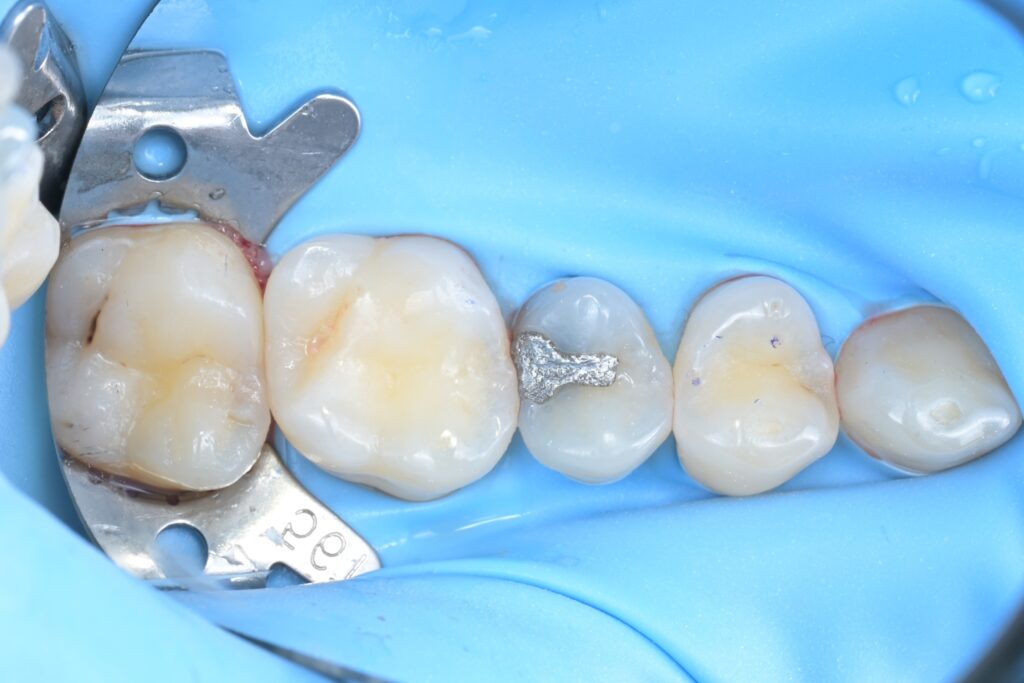 안전하고 정확한 치료를 위한 러버댐 장착