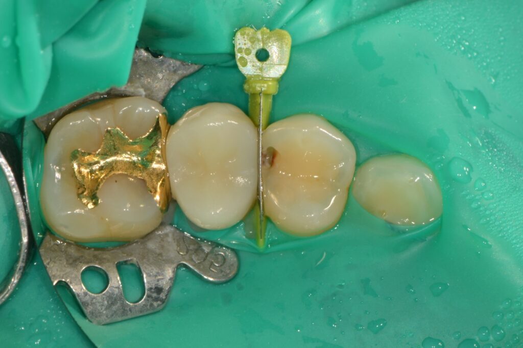 겉으론 멀쩡한데 속이 썩었다고요? 치아 사이 ‘인접면 충치’, 인레이 대신 ‘레진 빌드업’으로 치료한 증례 - 레진빌드업 임상사진