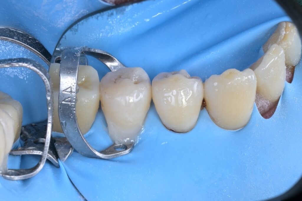 [치근우식] 잇몸 경계 부위가 썩었을 때, 왜 ‘러버댐’이 필수일까요? (Feat. 자연치아 살리기) - 레진빌드업 임상사진