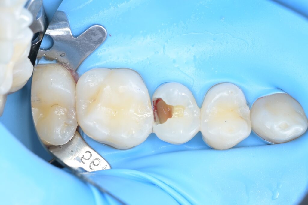 아말감 제거 직후: 재료 밑으로 깊게 퍼져있던 2차 우식 확인