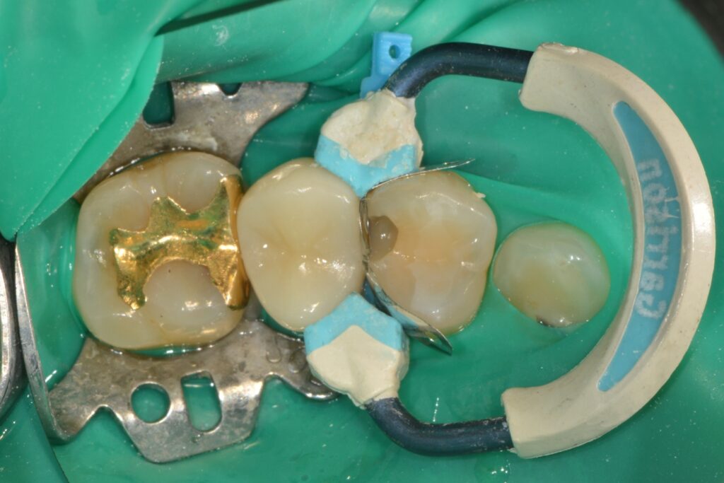 겉으론 멀쩡한데 속이 썩었다고요? 치아 사이 ‘인접면 충치’, 인레이 대신 ‘레진 빌드업’으로 치료한 증례 - 레진빌드업 임상사진