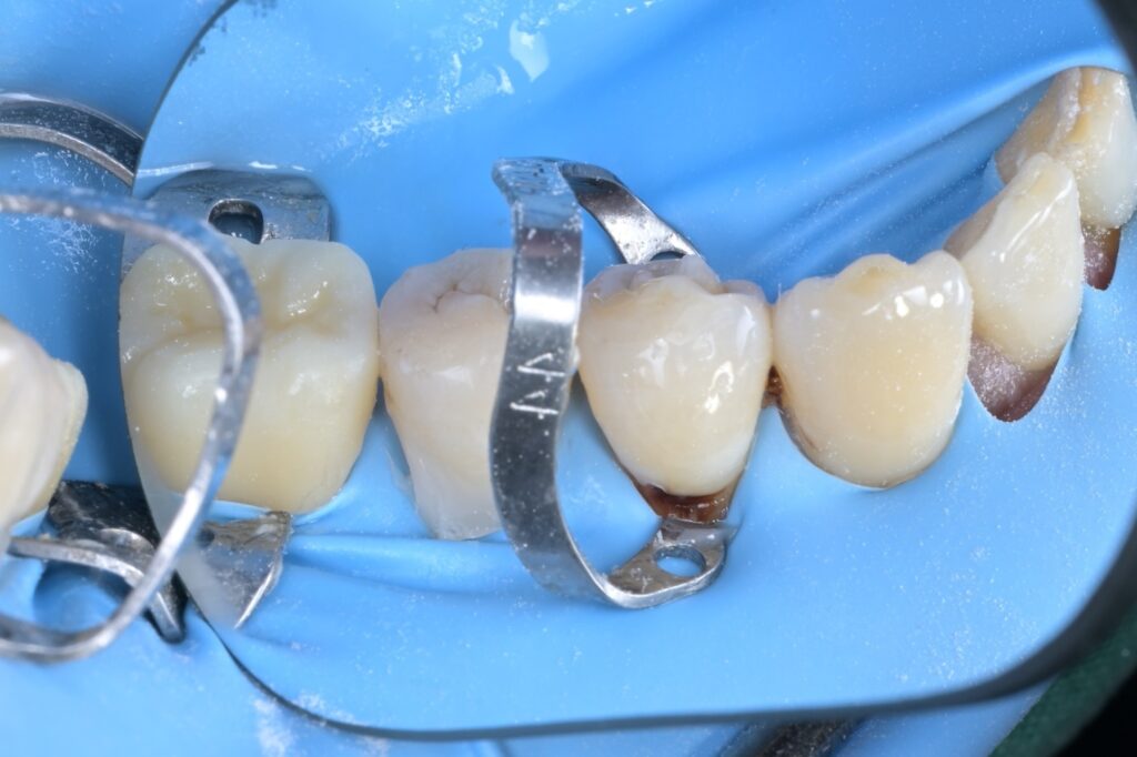 [치근우식] 잇몸 경계 부위가 썩었을 때, 왜 ‘러버댐’이 필수일까요? (Feat. 자연치아 살리기) - 레진빌드업 임상사진