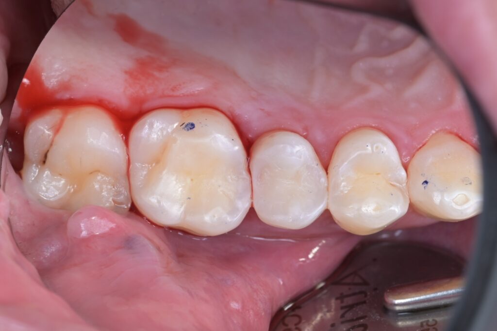 치료 종료: 주변 치아와 구분이 어려울 만큼 자연스러운 결과