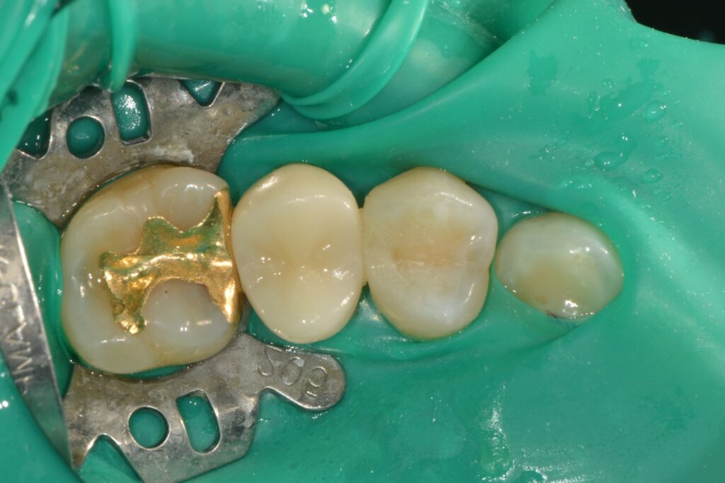 겉으론 멀쩡한데 속이 썩었다고요? 치아 사이 ‘인접면 충치’, 인레이 대신 ‘레진 빌드업’으로 치료한 증례 - 레진빌드업 임상사진