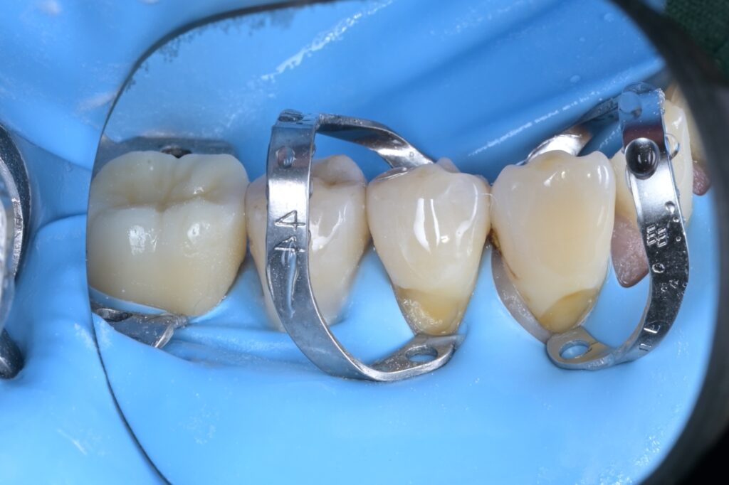 [치근우식] 잇몸 경계 부위가 썩었을 때, 왜 ‘러버댐’이 필수일까요? (Feat. 자연치아 살리기) - 레진빌드업 임상사진