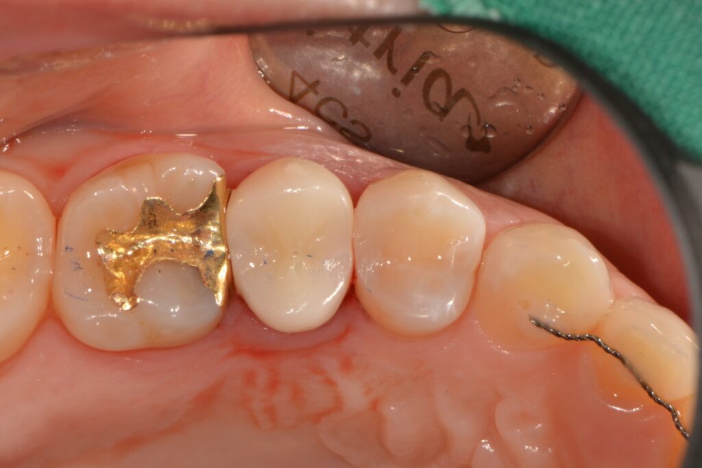 겉으론 멀쩡한데 속이 썩었다고요? 치아 사이 ‘인접면 충치’, 인레이 대신 ‘레진 빌드업’으로 치료한 증례 - 레진빌드업 임상사진