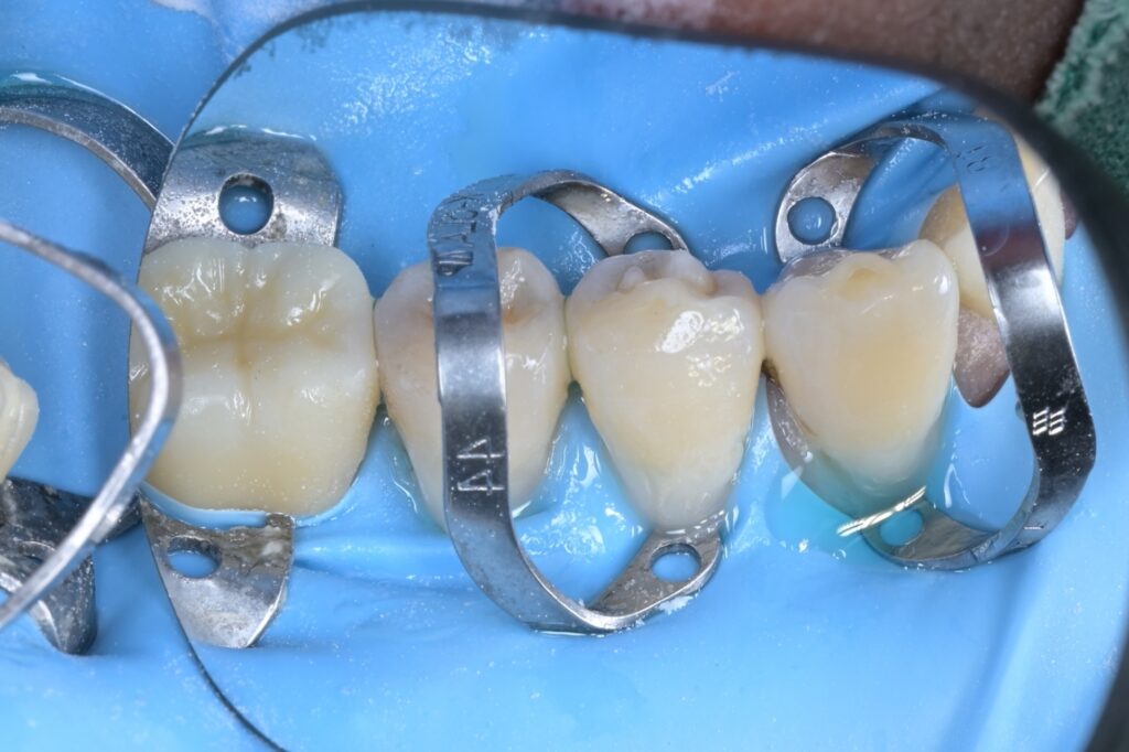 [치근우식] 잇몸 경계 부위가 썩었을 때, 왜 ‘러버댐’이 필수일까요? (Feat. 자연치아 살리기) - 레진빌드업 임상사진