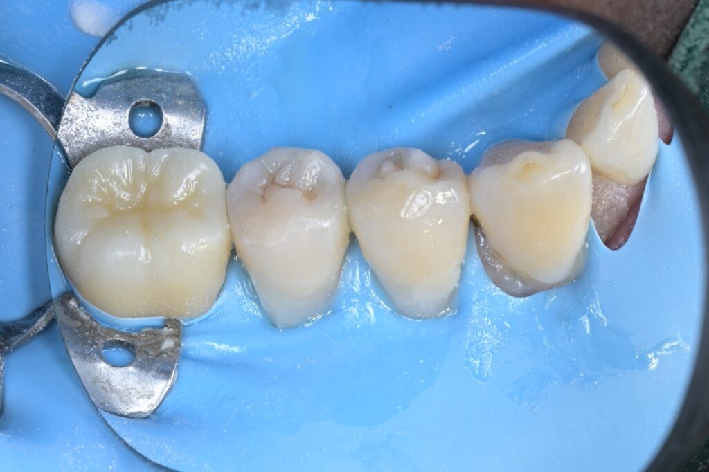 [치근우식] 잇몸 경계 부위가 썩었을 때, 왜 ‘러버댐’이 필수일까요? (Feat. 자연치아 살리기) - 레진빌드업 임상사진