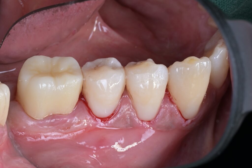 [치근우식] 잇몸 경계 부위가 썩었을 때, 왜 ‘러버댐’이 필수일까요? (Feat. 자연치아 살리기) - 레진빌드업 임상사진