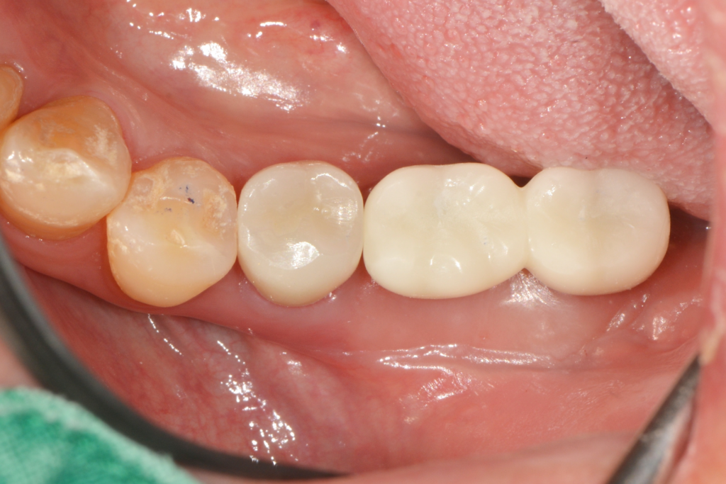 임플란트, 잇몸 뼈만 중요할까요? ‘단단한 잇몸’을 만들어 수명을 늘린 케이스 (FGG/전정성형술) - 잇몸성형수술 임상사진