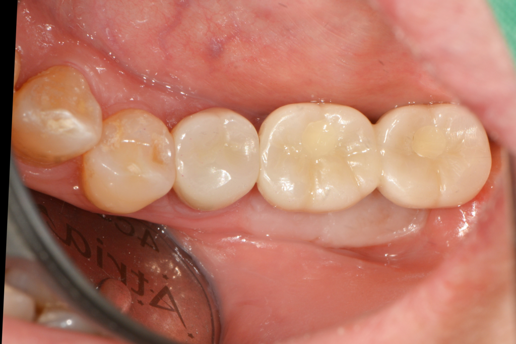 임플란트, 잇몸 뼈만 중요할까요? ‘단단한 잇몸’을 만들어 수명을 늘린 케이스 (FGG/전정성형술) - 잇몸성형수술 임상사진