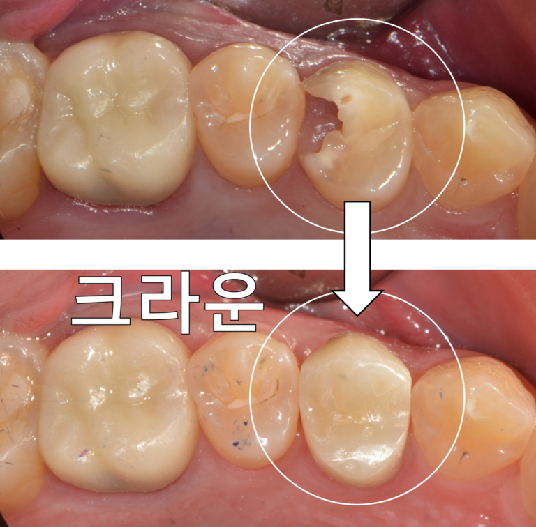 “잇몸이 치아 안으로 자라 들어왔어요…” 발치 선고받을 뻔한 치아, 잇몸 수술과 레진 벽(Wall)으로 살려낸 과정 - 레진빌드업 썸네일