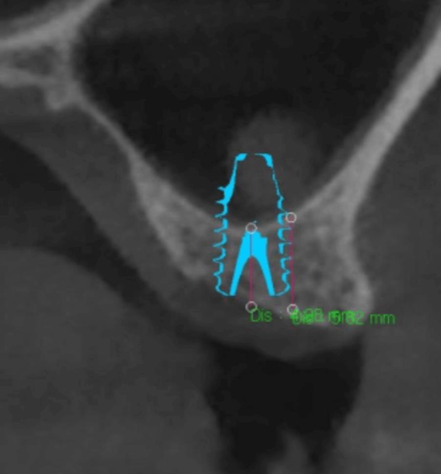 상악동 무절개 임플란트, 고난도 수술로 가능한 케이스 - 임플란트 임상사진