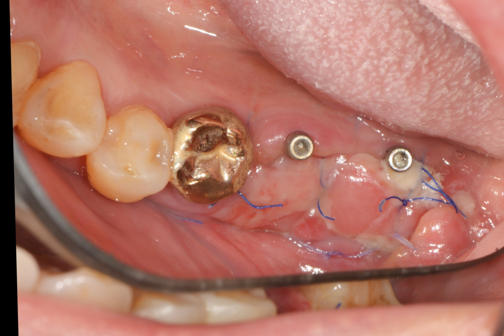 임플란트, 잇몸 뼈만 중요할까요? ‘단단한 잇몸’을 만들어 수명을 늘린 케이스 (FGG/전정성형술) - 잇몸성형수술 임상사진