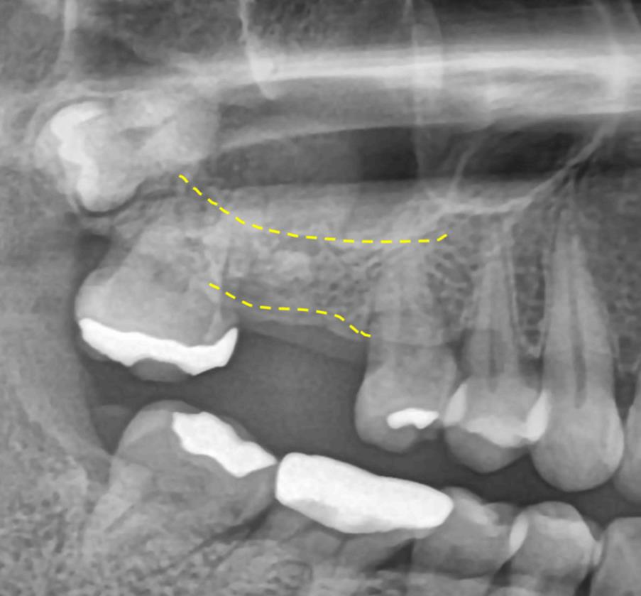 상악동 무절개 임플란트, 고난도 수술로 가능한 케이스 - 임플란트 임상사진