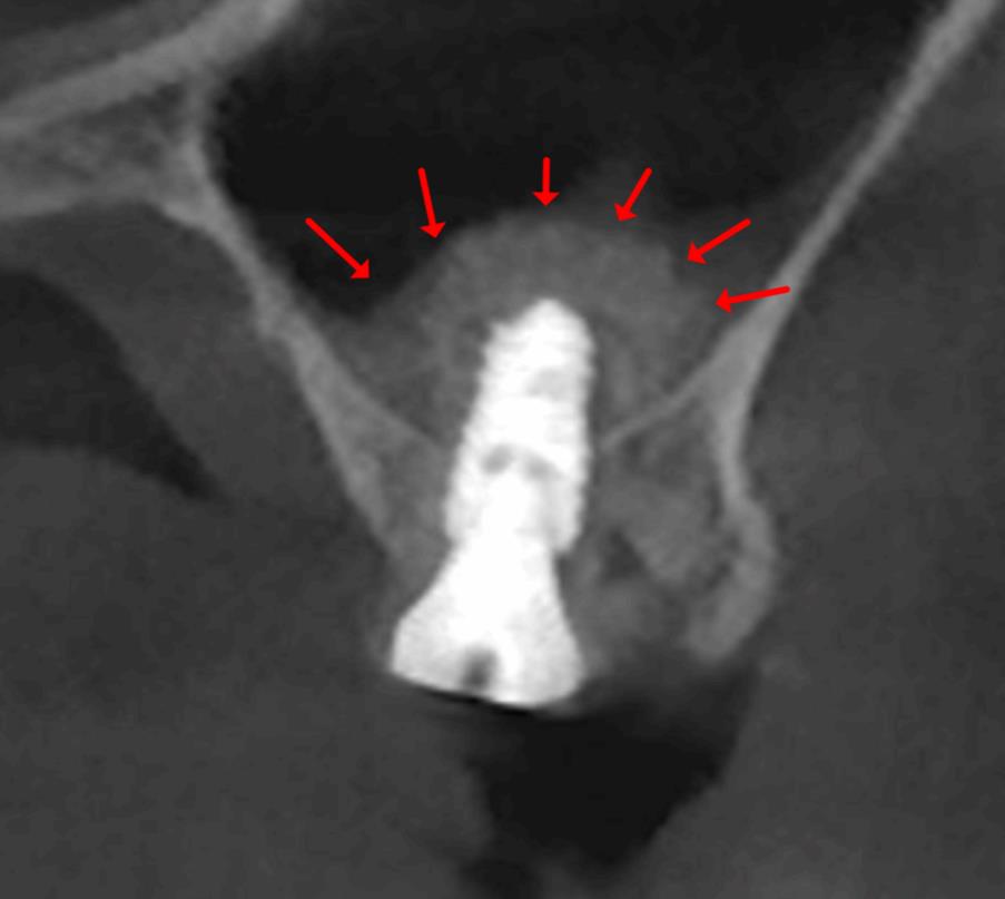 상악동 무절개 임플란트, 고난도 수술로 가능한 케이스 - 임플란트 썸네일
