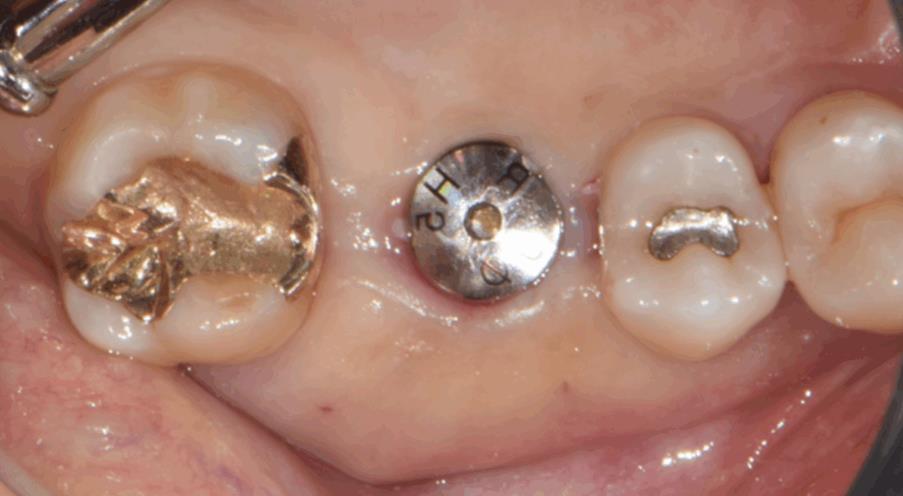상악동 무절개 임플란트, 고난도 수술로 가능한 케이스 - 임플란트 임상사진