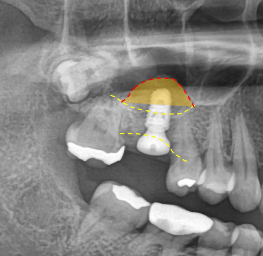 상악동 무절개 임플란트, 고난도 수술로 가능한 케이스 - 임플란트 임상사진